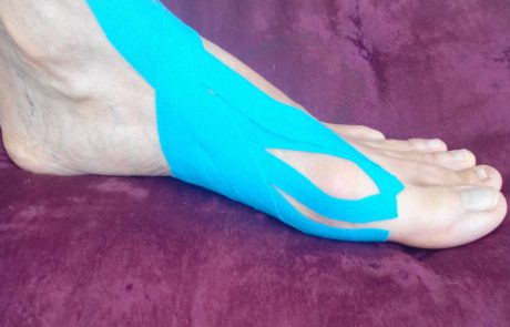 הלוס ואלגוס – hallux valgus
